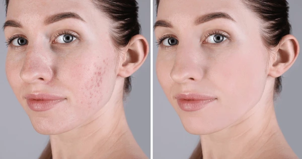 Before and After result A
